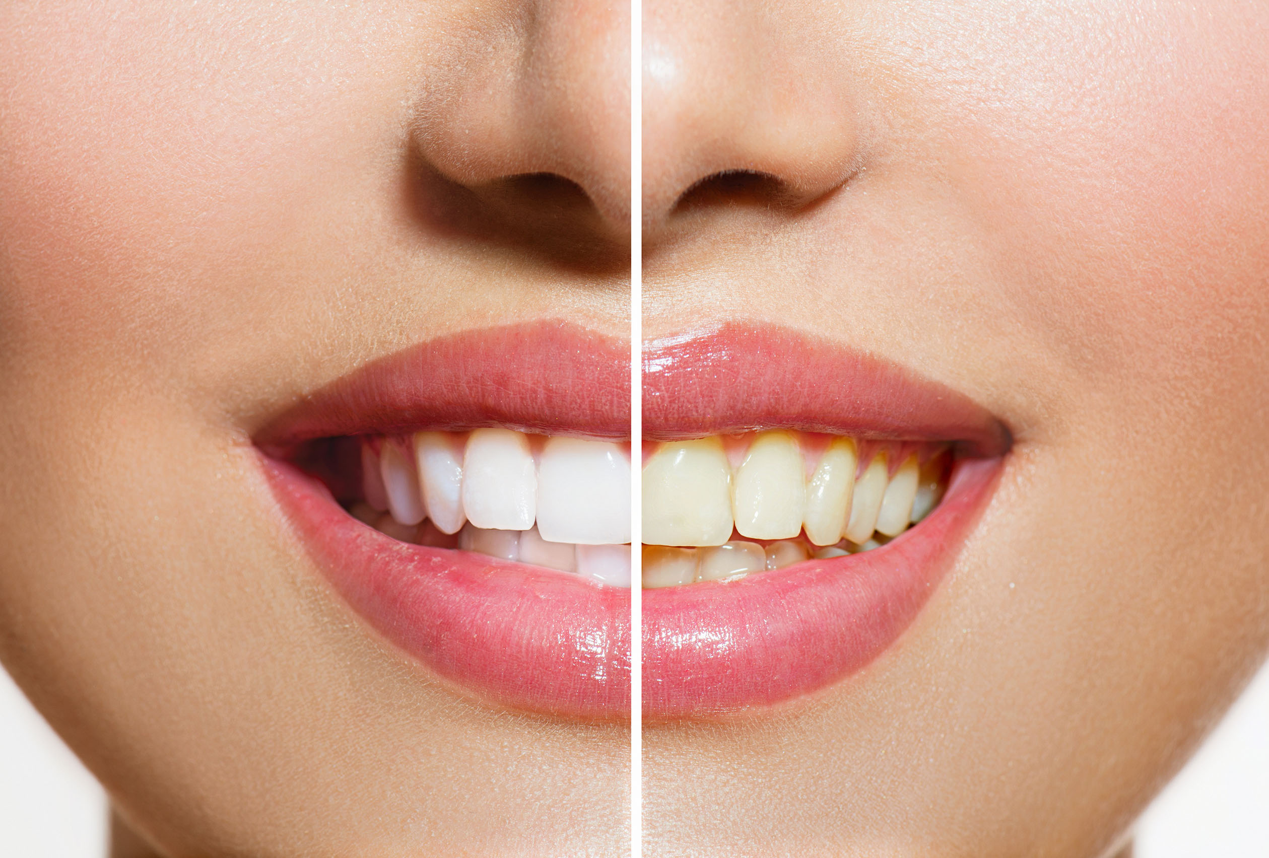 smiling teeth whitening Jensen Family Dentist Bayport, MN