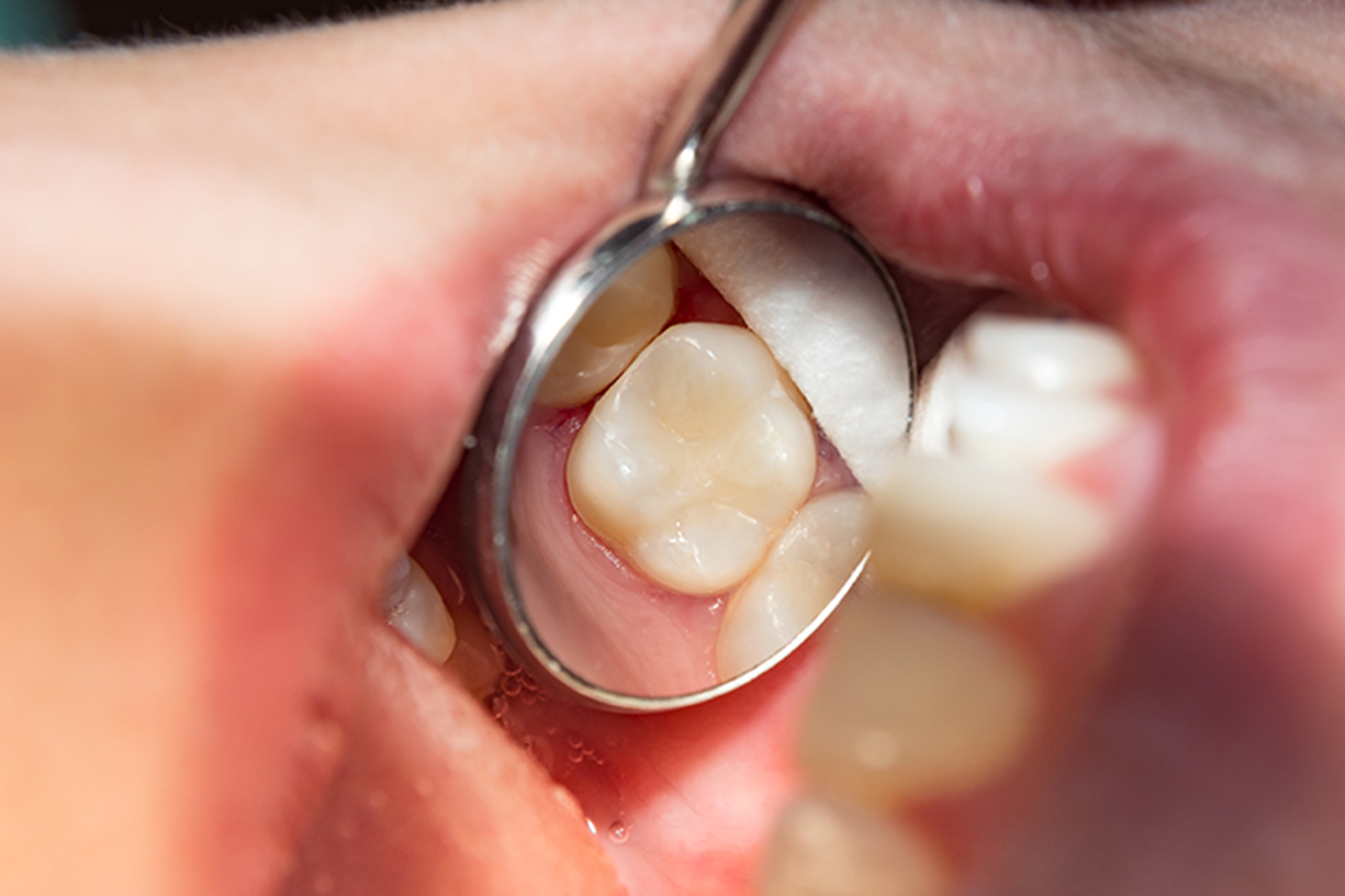 Tooth-Colored Fillings in Bayport MN - Dental Fillings